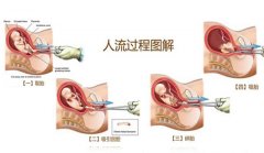 哪些妇科疾病治疗完才能试管？