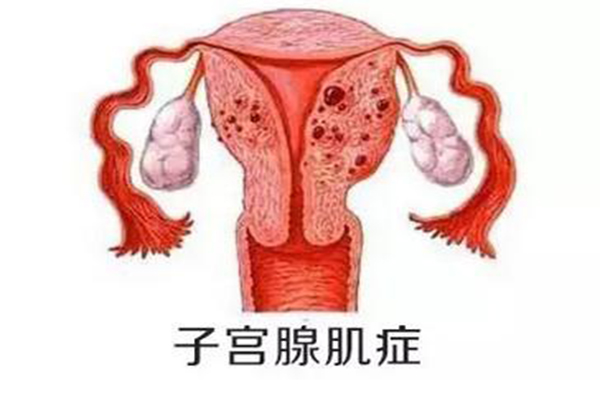 子宫腺肌症